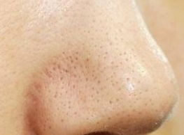 小鼻を気にしている男性多発 小鼻の黒ずみ イチゴ鼻 の対策方法